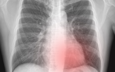Pneumothorax Updates in Diagnosis and Management CME